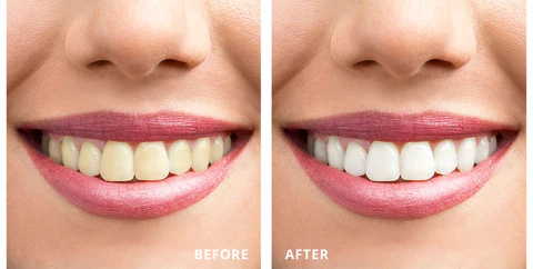 PearlWhite™ Teeth Whitening Pen